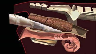 直腸掏糞示意圖